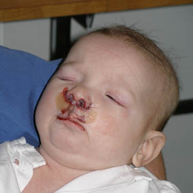 Robin på uppvaket efter sin första operation; läppen